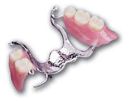 Cast Partial Upper Denture