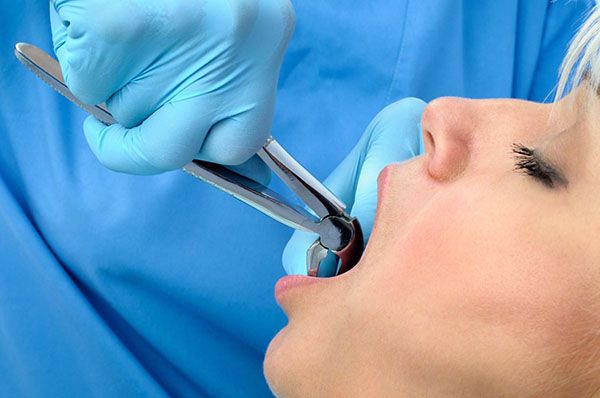 tooth extractions ek dental surgery dentist glen waverley