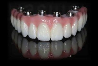 dental rehabilitation implants ahmedabad