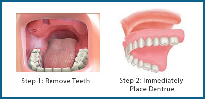 immediate-denture treatment Ahmedabad