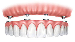 implant-denture treatment ahmedabad