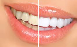 TEETH WHITENING ahmedabad