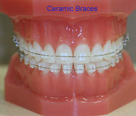 ceramic-braces1