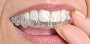 clear-aligners