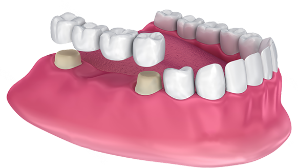 dental crowns ahmedabad