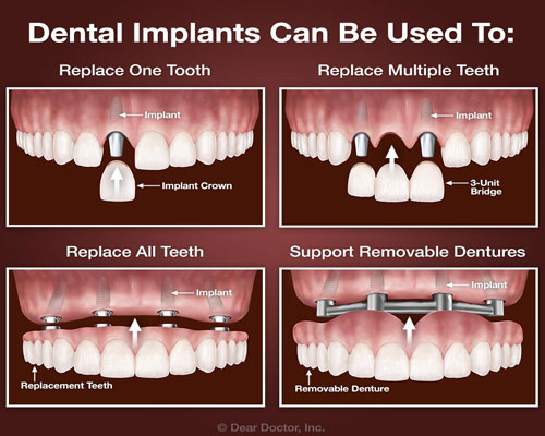 Dental Implant Treatment ahmedabad