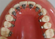 Lingual Braces