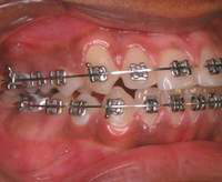metal-braces-11