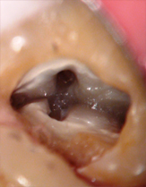 MICROSCOPIC IMAGE OF MOLAR WITH 4 CANALS