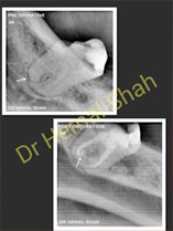 ROOT CANAL EXTREMELY CURVED AT THE APEX