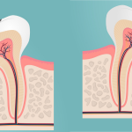 root canal treatment ahmedabad